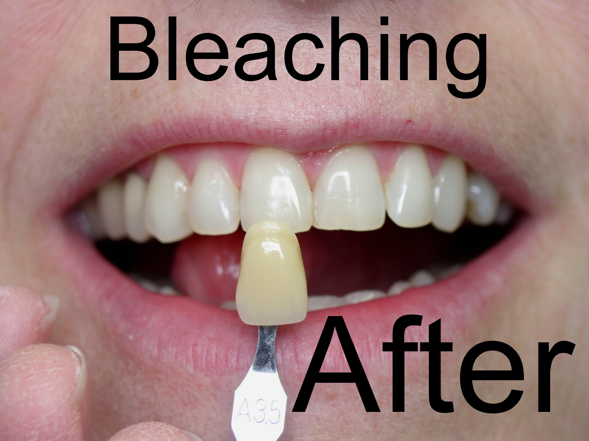 Bleaching After